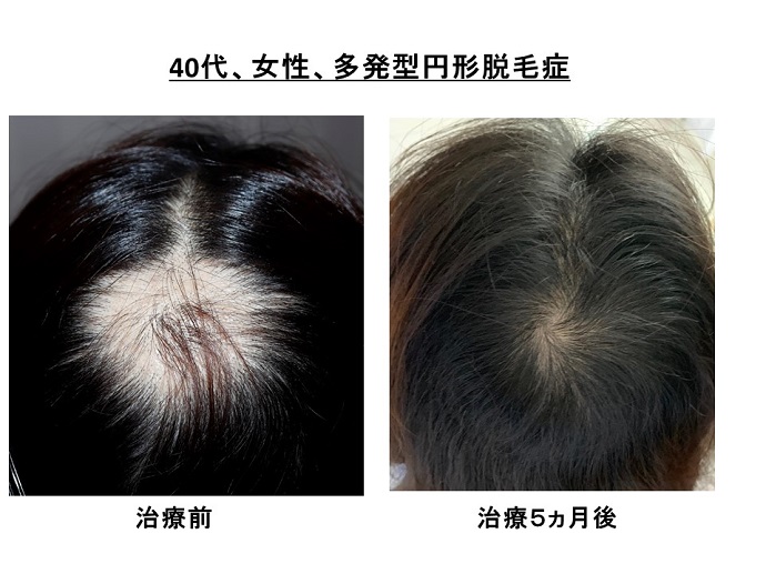 脱毛 症 治療 円形